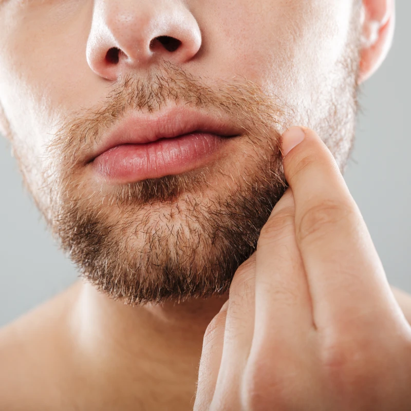 زراعة اللحية ( Beard Transplant )