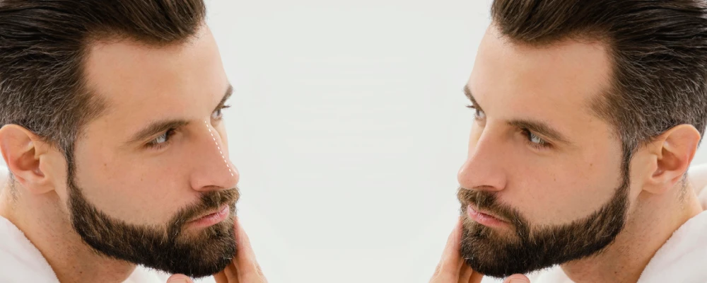 زراعة اللحية